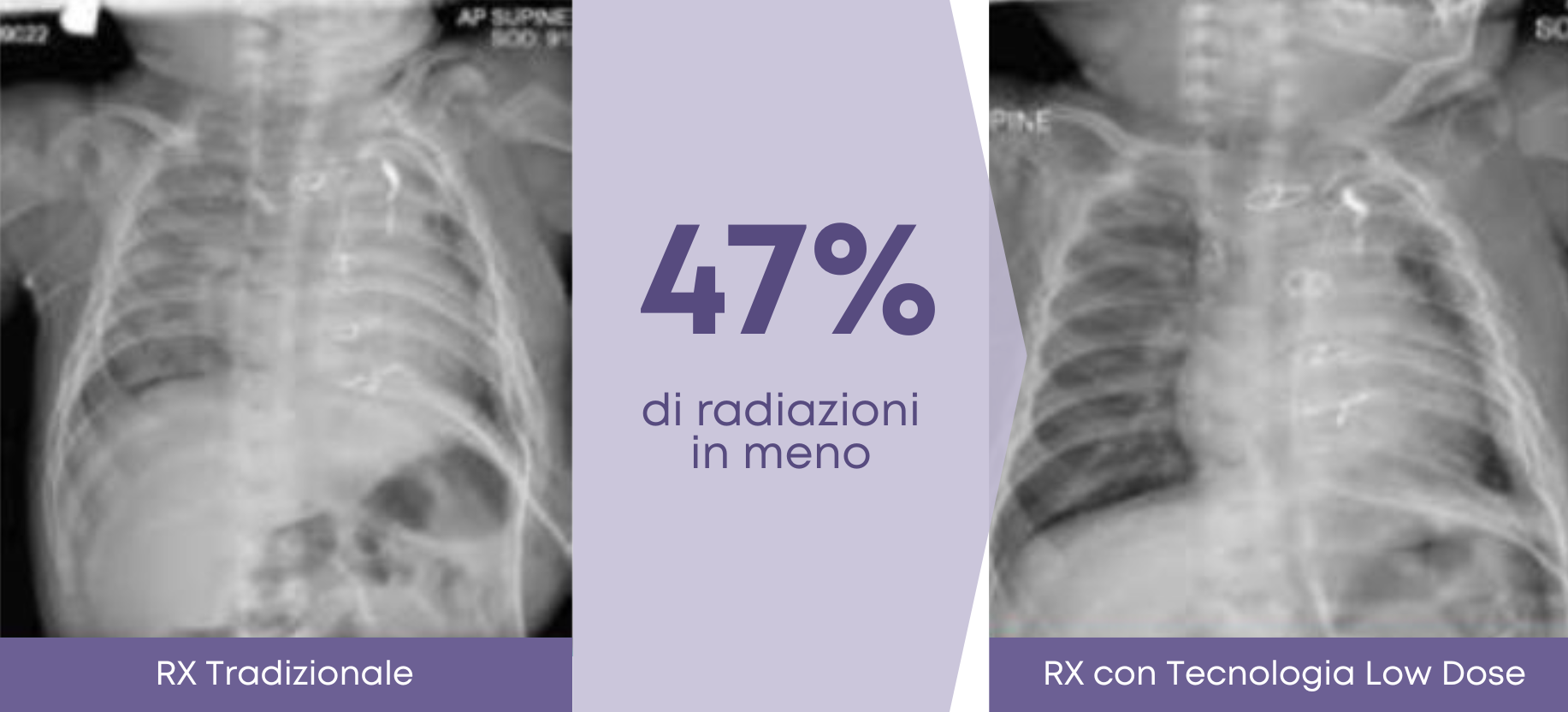 rx digitale dosaggio inferiore radiazioni riccione salute